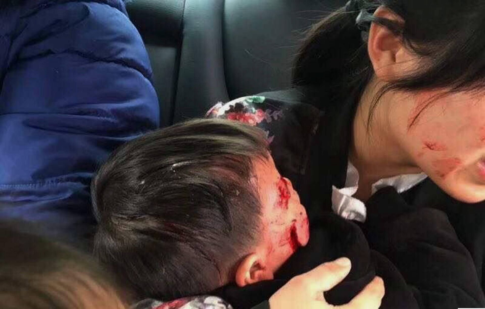 6岁男孩天天(化名)被一条黑狗扑倒后咬伤面部,后被诊断为狂犬病