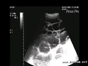 卵巢多发性囊肿