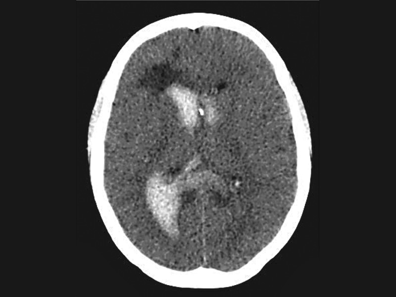 intracranial hemorrhage