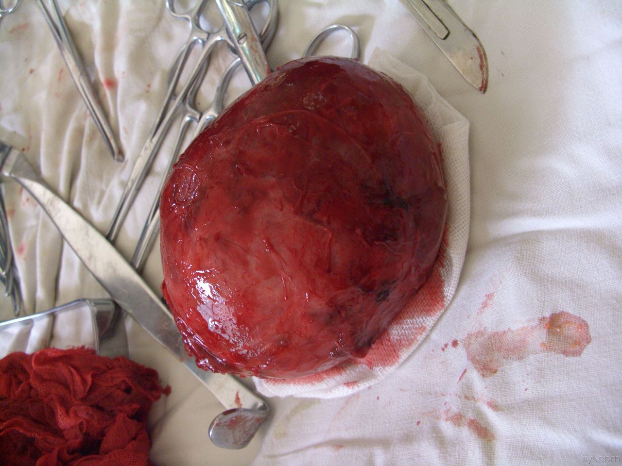  p>甲状腺囊腺瘤症状是 a href="#" data-lemmaid="3621016">毒性弥漫