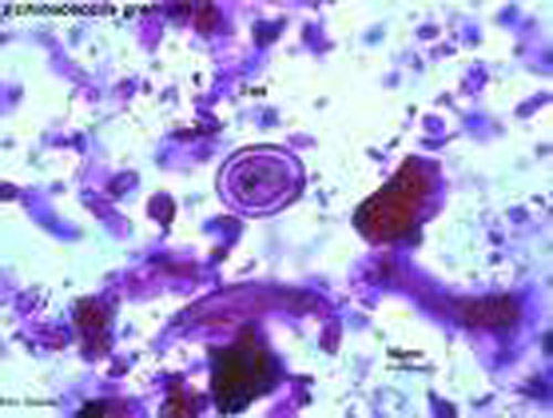 细粒棘球绦虫病