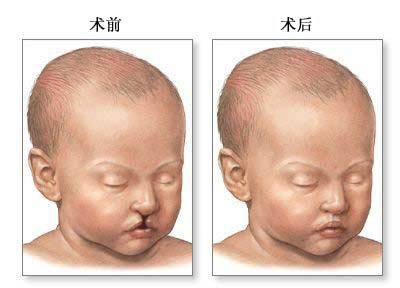  p>唇腭裂是一种先天的唇畸形,也就是我们常说的兔唇,对于唇腭裂的