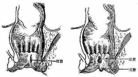 陈旧性肛裂