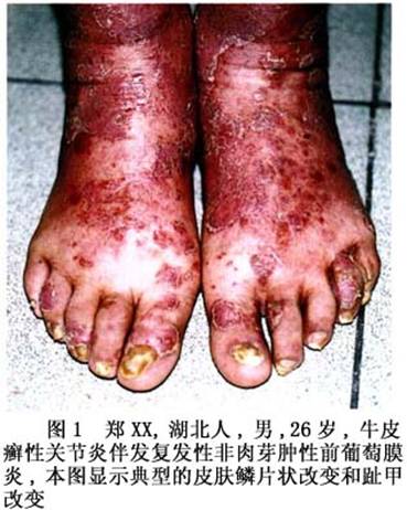 arthritis)是一种血清阴性(即血清类风湿因子阴性)的关节炎,典型地