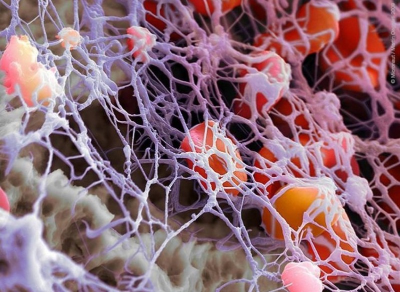  p>血纤维蛋白(fibrin)是一种 a target="_blank" href="/item/蛋白质