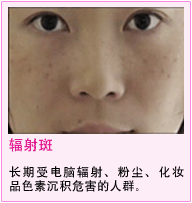电脑辐射斑