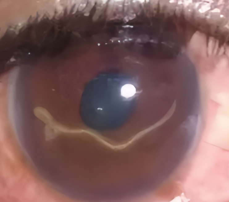 犬眼线虫
