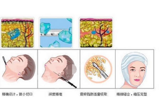 脸部抽脂