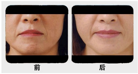 在其两侧的唇弓最高点称为唇峰. /p>