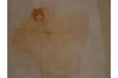 为什么分泌物有腥臭味