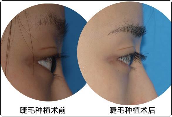 眉毛移植