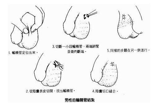  p>男人结扎:一般的结扎都是行 a href="#" data-lemmaid="5816925">