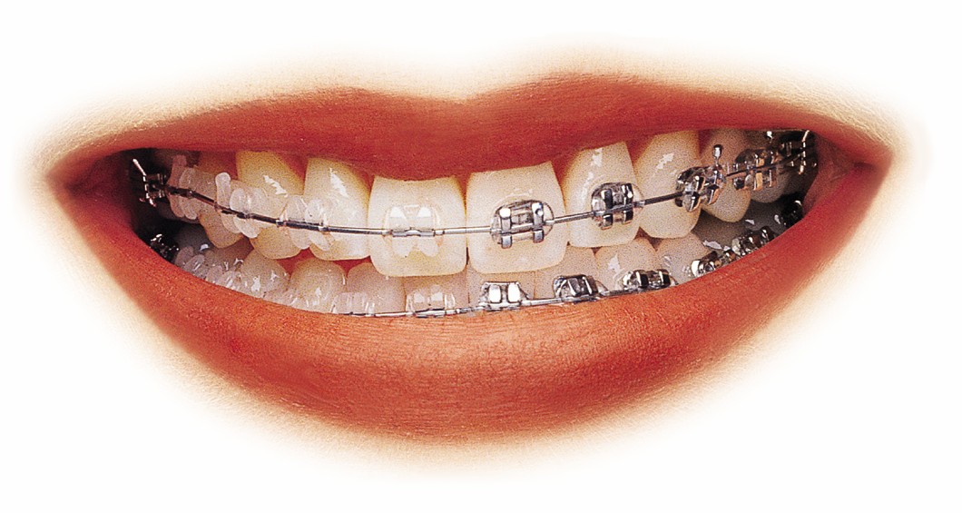  p data-id="gnbap1d6us"> b>3m陶瓷托槽: /b>牙套或牙箍医学上称为