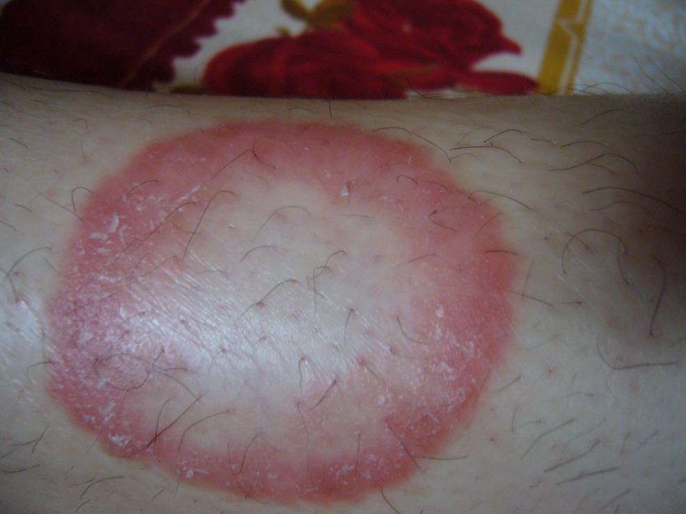  p>环形红斑是 a target="_blank" href="/item/风湿热/5055111" data