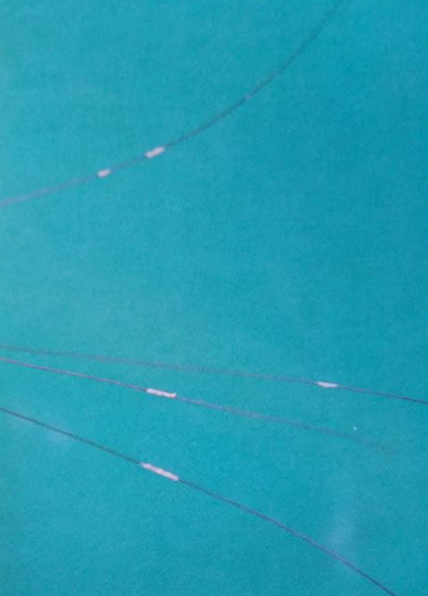  p data-id="gnxbfrlnyg">管型毛发是一种毛发异