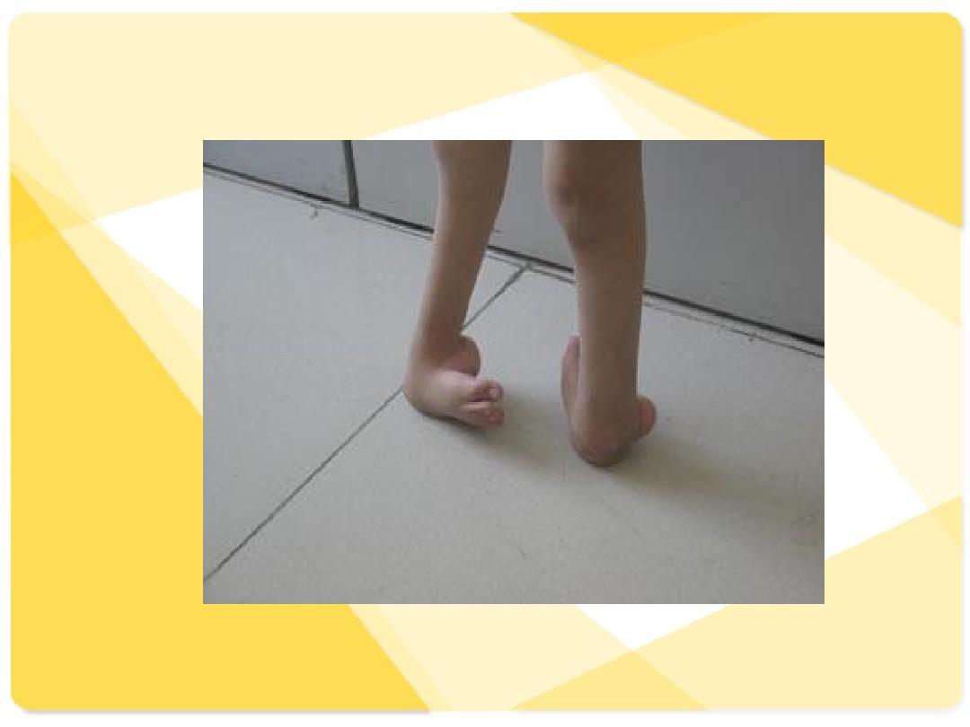  p>马蹄足内翻即足内翻呈马蹄状,主要分为 a href="#" data-lemmaid="