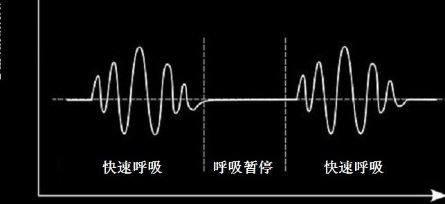 病人出现潮式呼吸,离死亡还有多久 - 知晓星球