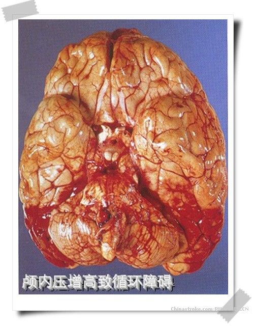 颅内压增高综合症