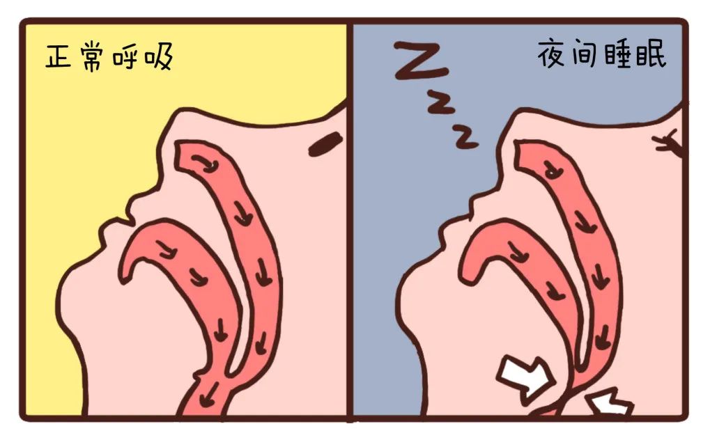 扁桃体肥大,舌部过大,过度饮酒等会引发打鼾.