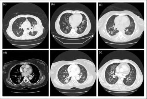 pulmonarymucormycosis