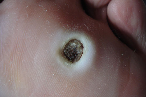  p>跖疣是发生在足跟,跖骨头或跖间的寻常疣,是由乳头瘤病毒所引起的