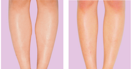  p>肉毒素瘦小腿是临床上最佳瘦腿方法,通过注射的方法来控制肌肉的