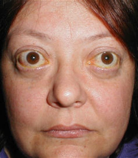 甲状腺病态综合症