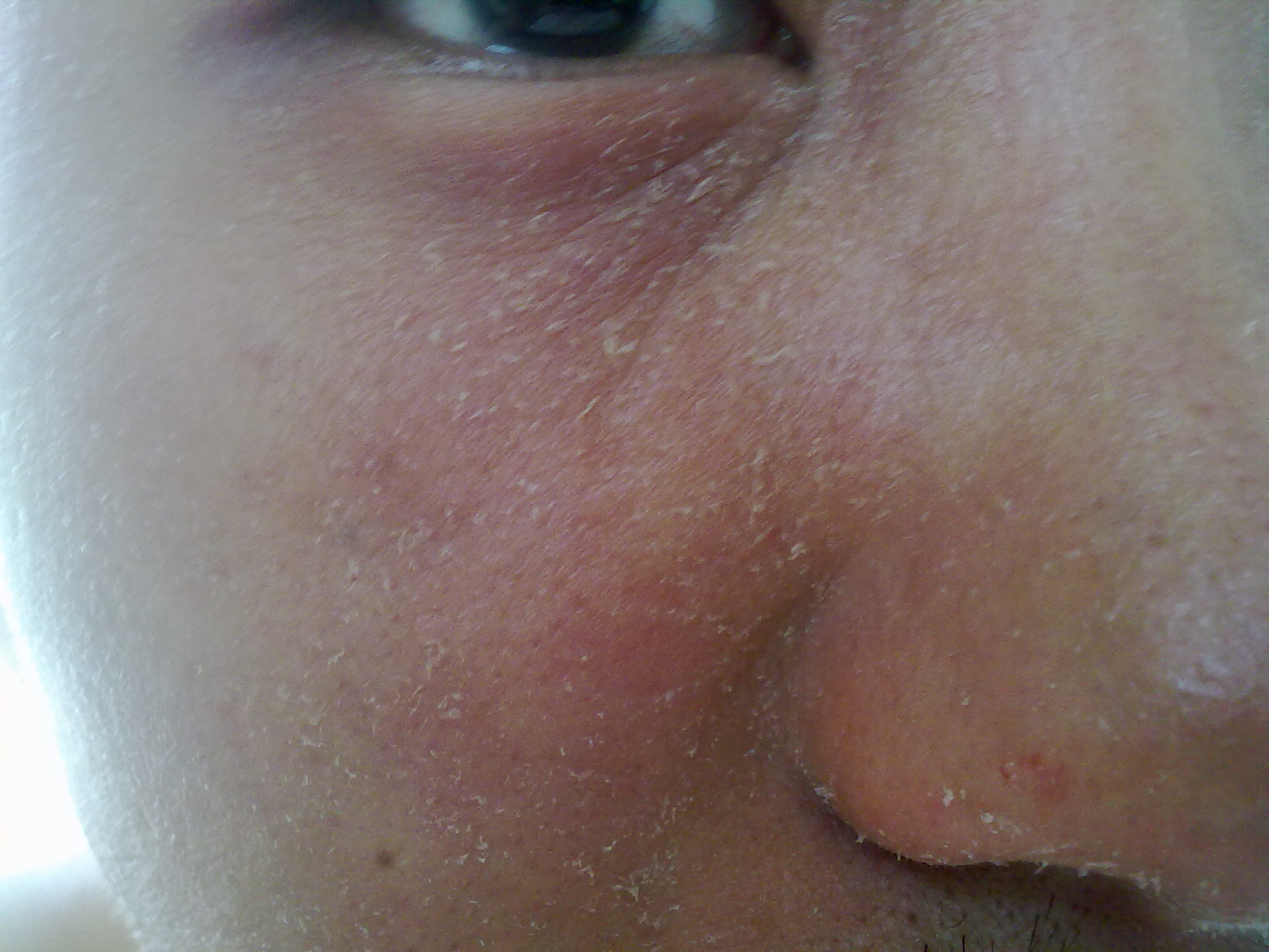 皮肤干燥综合症