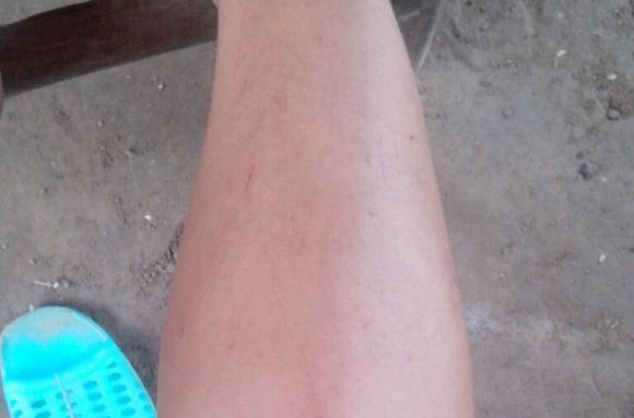  p> a href="#">孕期胆汁淤积症, /a>只在孕期发生,并在 a href="#"