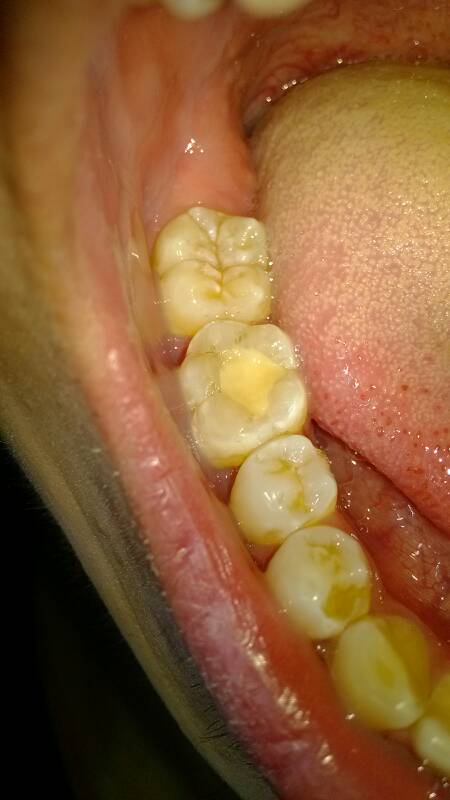  p data-id="gnvharo0sa">"龋齿",俗称"虫牙","蛀牙",是人类发病率极