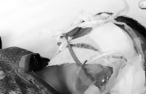 8·24山西临汾男童被挖眼案