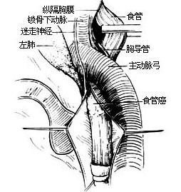 data-lemmaid="957242">食管癌 /a>切除术是用于治疗食管癌的手术方法