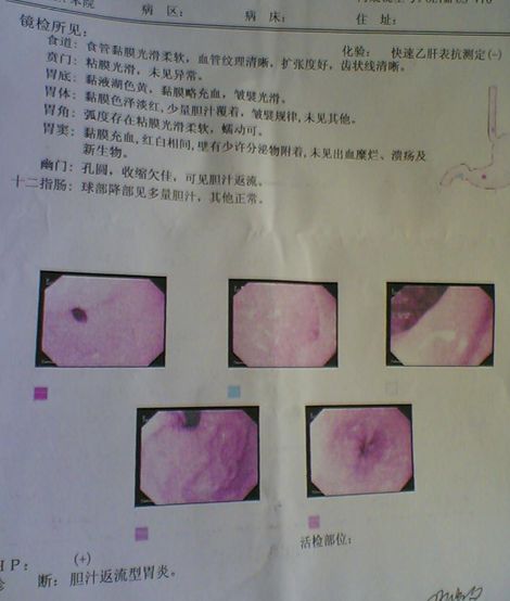 胆汁返流性胃炎