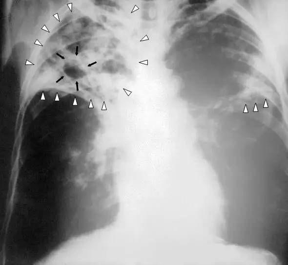 科学网—[转载]结核分枝杆菌（M. tuberculosis），俗称结核杆菌（tubercle bacillus），是引起结核病的病原体 ...