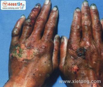 生成卟啉症比较常见的一种是急性间歇型卟啉症(aip),使患者严重贫血