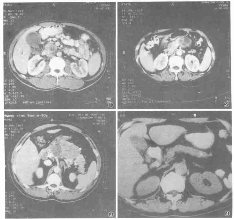 胰腺癌转移肝癌