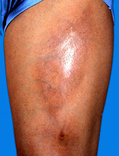 硬化及萎缩为特点的结缔组织病,其主要特点为皮肤,滑膜,骨骼肌,血管和