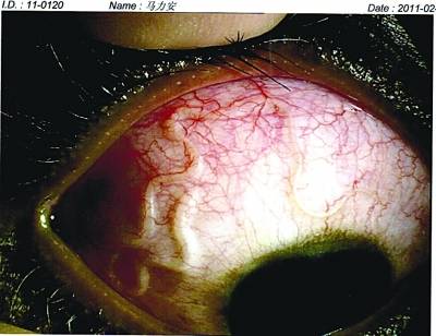  p>眼睛寄生虫以 a href="#" data-lemmaid="3224299">裂头蚴 /a>和猪