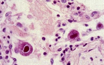  p>巨细胞病毒(cytomegalovirus)是一种 a href="#">疱疹病毒 /a>组