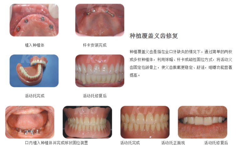 lemmaid="10516549">牙根 /a>与牙冠上的一种全口义齿或可摘局部义齿