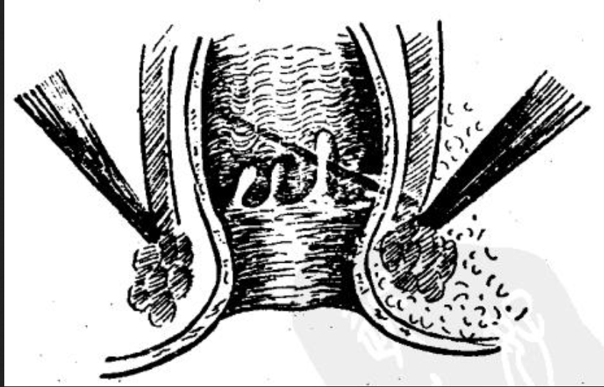  p>肛门瓣下方的 a target="_blank" href="/item/三角形/179552"