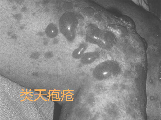 大疱性类天疱疮