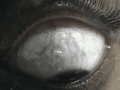  p>眼睛寄生虫以 a href="#" data-lemmaid="3224299">裂头蚴 /a>和猪