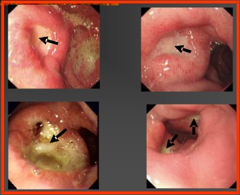  p>十二指肠溃疡伴幽门梗阻(gastroduodenal ulcer with pyloric