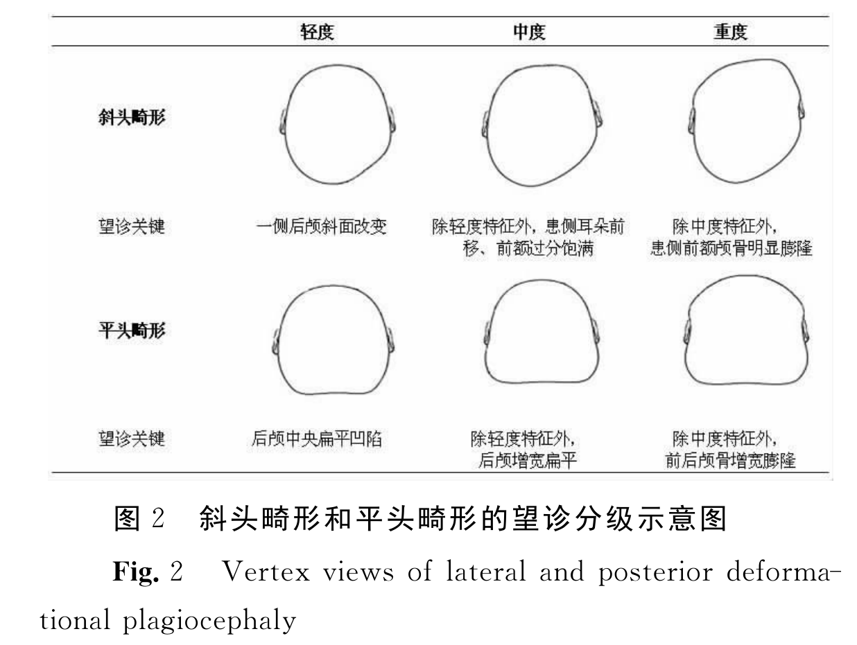扁头综合征