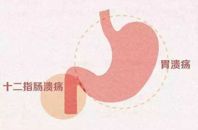 十二指肠球部