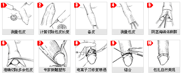 包皮环切手术