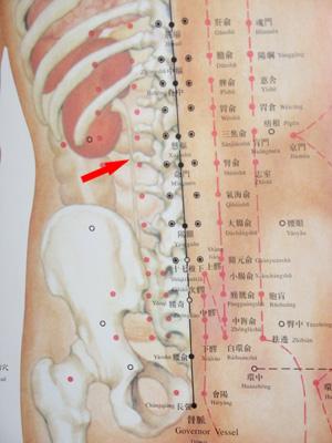 第三腰椎横突综合症
