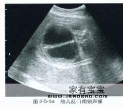 ="1154939">胸锁乳突肌 /a>的先天性单侧挛缩,导致头和颈的不对称畸形