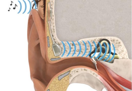  p>植入式助听器,又称为骨传导助听器,是瑞典查尔默斯技术大学的科学